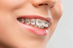 Braces & Teeth