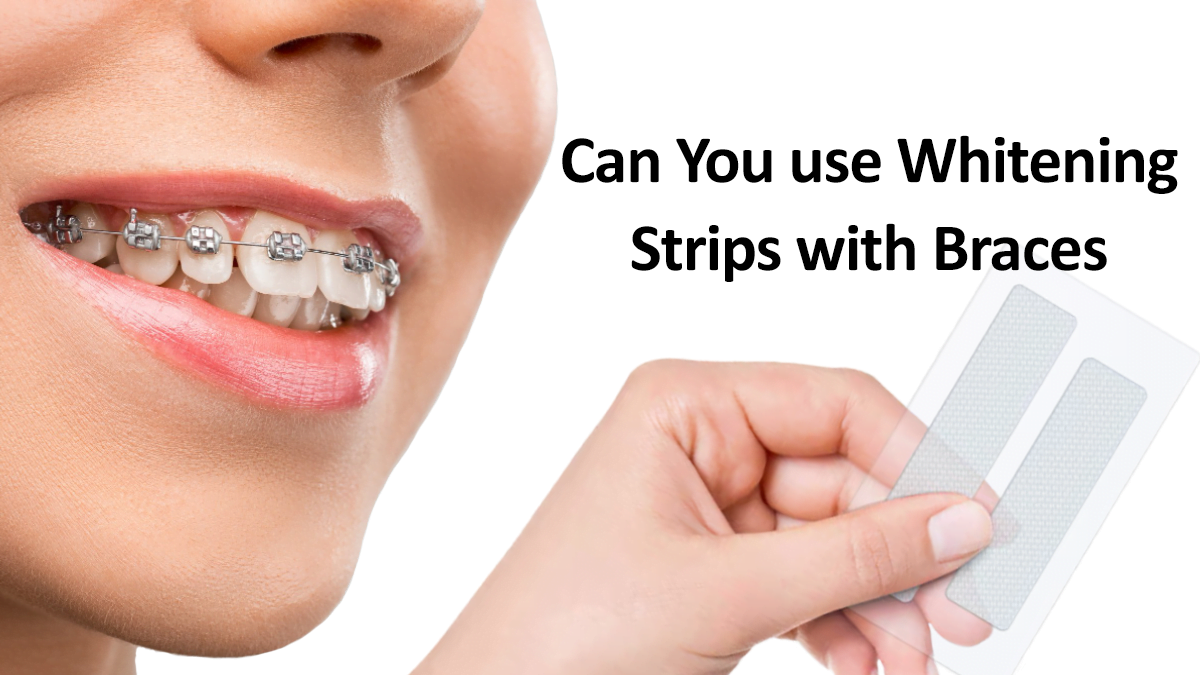 Can you use Whitening Strips with Braces and Not Risk Safety?