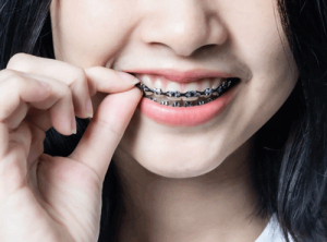 Whitening Teeth while Wearing Braces
